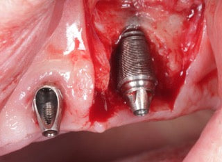 Peri Implantitis